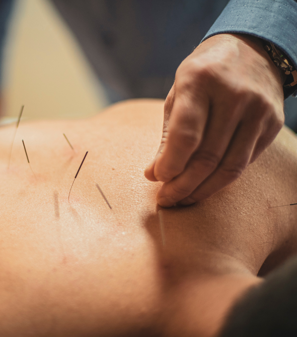 针灸 Acupuncture
